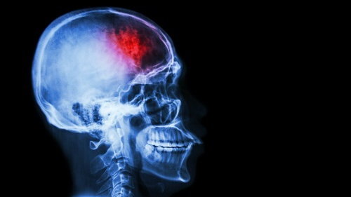 Naukowiec z "uczelni Rydzyka" przestrzega przed chipami w mózgu