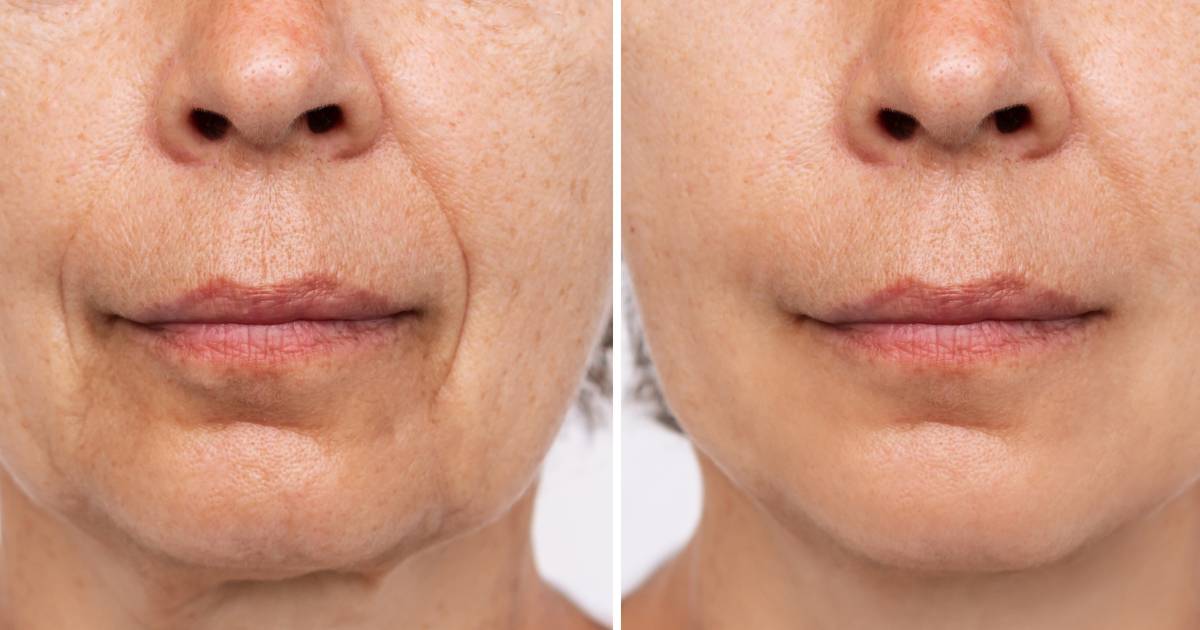 To japońskie serum do twarzy działa jak lifting bez skalpela! Likwiduje zmarszczki marionetki