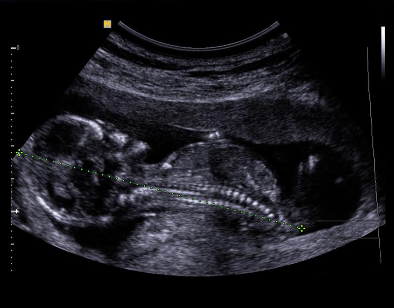 13. týždeň tehotenstva: Na prenatálny skríning som napokon išla -  Tehotenstvo: príbeh z pohľadu ženy | Najmama.sk