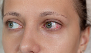 Zespół suchego oka – najskuteczniejsze sposoby na pozbycie się problemu