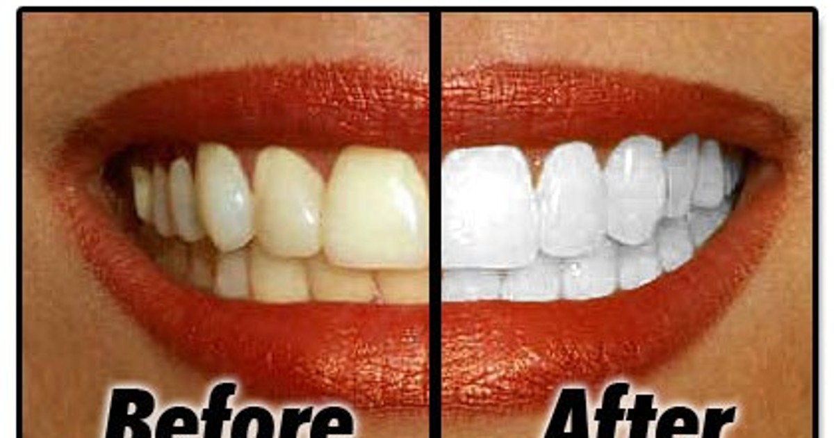 Clean teeth are not hard to get Pulse Nigeria
