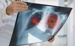 Listopadowa lista refundacyjna – być albo nie być dla pacjenta z rakiem płuca