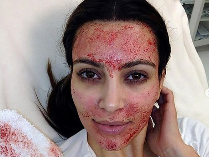 Kim Kardašijan na "vampirskom tretmanu" od koga su žene dobile HiV