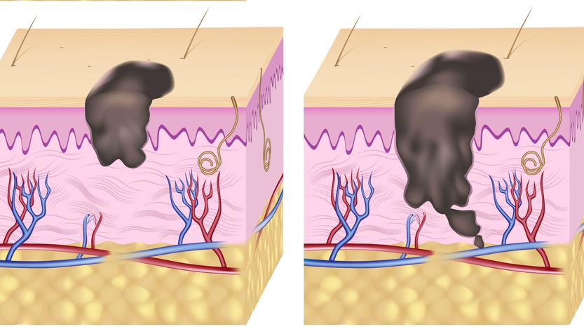bőrrák, melanoma, korai tünet, tünet