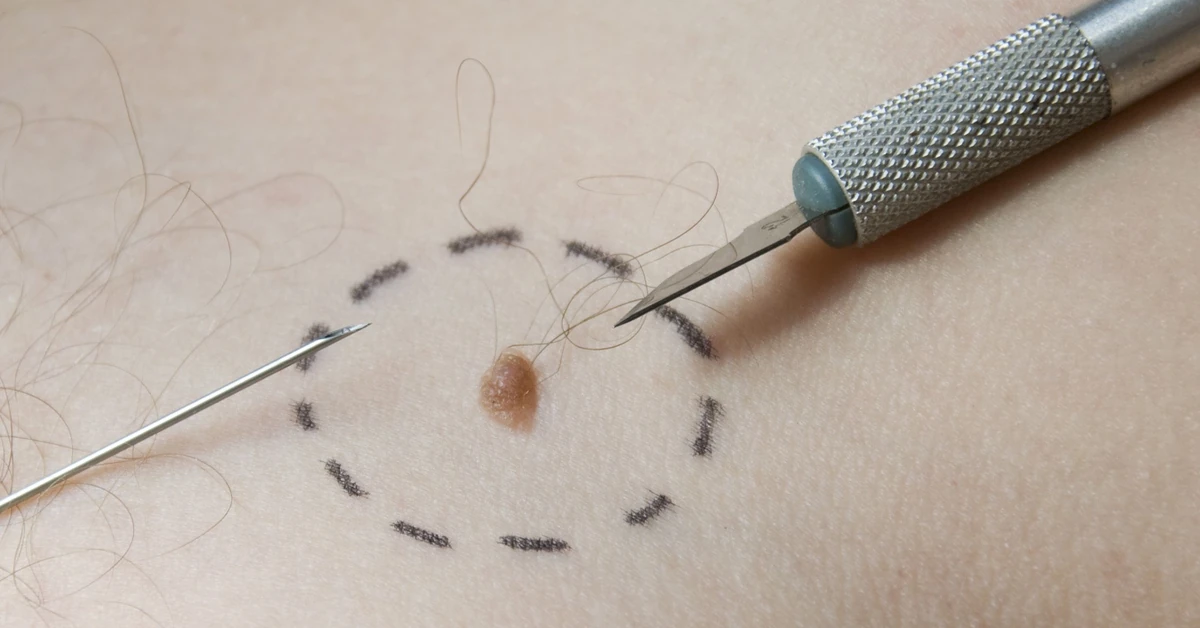 Jak uchronić skórę przed czerniakiem? najważniejsze zasady profilaktyki