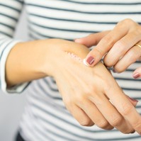 Ha így ápolja a hegeit, nagyobb eséllyel múlnak el nyomtalanul