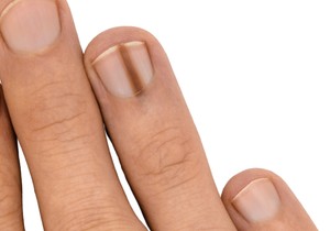 Melanom noktiju je agresivan tip raka kože koji se javlja kao tamnosmeđa ili crna linija na noktu