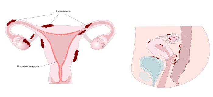 Endometriózis: a bordó, megvastagodott endometriumok a méhben és a környező szerveken is láthatók