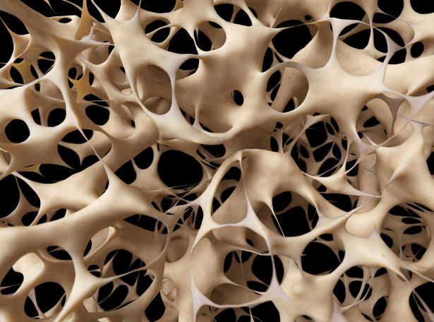 Osteoporoza - cichy złodziej kości. Zagraża 8 mln Polaków