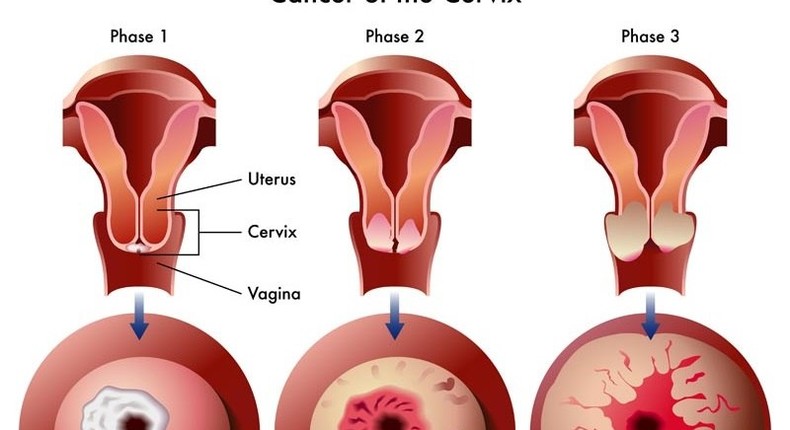 Stages of Cervical Cancer