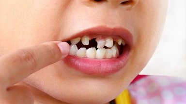 Usunęli dziecku 526 zębów. Miało rzadką chorobę