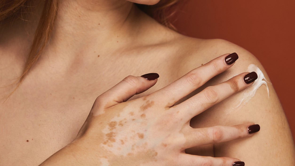 Vitiligo je autoimunitné ochorenie charakterizované stratou pigmentu kože a vznikom bielych fľakov na pokožke. 