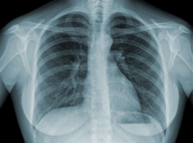 Kto najczęściej choruje na gruźlicę