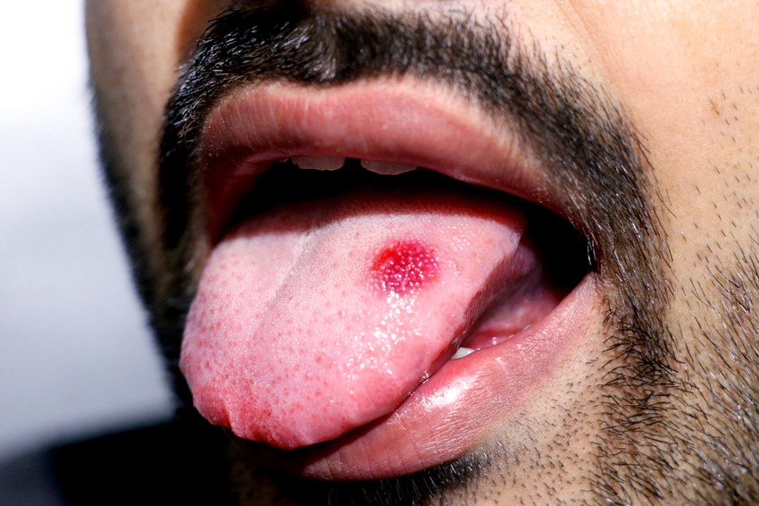 In the division according to the WHO, 7 forms are distinguished: reticular, papular, plaque, atrophic, erosive, ulcerative and bullous.  They often appear as white patches, red spots, red swollen areas, or even open sores.  Red, inflamed lesions and sores can cause a painful burning sensation.