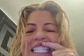 Otišla u Tursku po NOVE ZUBE, a vratila se sva otečena i bez PREBIJENE PARE: "Zašili su mi desni za obraz, toliko boli da bih SKOČILA S LITICE"