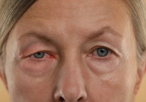 Periorbitalni edem se javlja zbog nakupljanja tečnosti oko oka