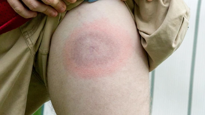 Укус кліща - що робити?