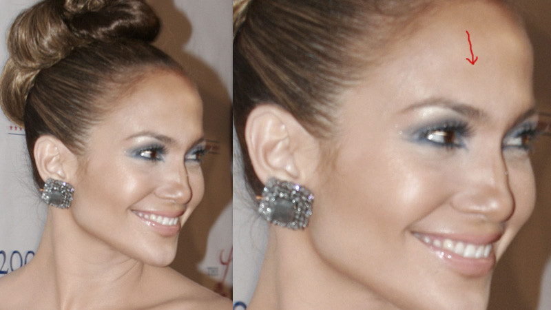 Jennifer Lopez wstrzykuje sobie BOTOKS