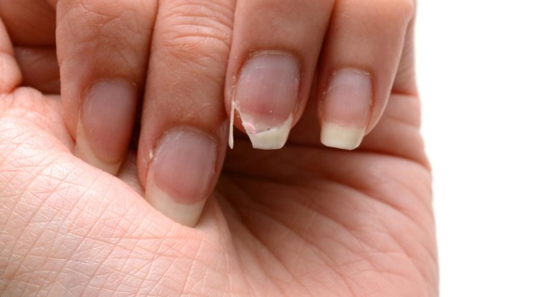 Weak nails (The Woodruff Institute)