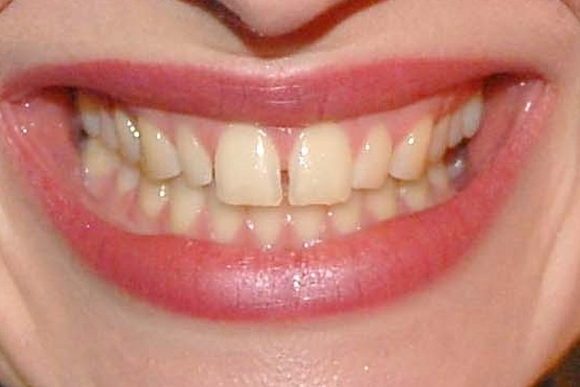 Zęby Mai Hirsch