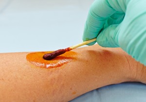 Neželjene reakcije na jod su retke 