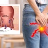 Svrab zbog hemoroida noću nije samo subjektivni osećaj, postoje realni razlozi za noćnu agoniju