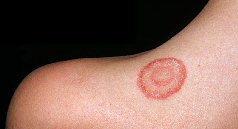 What causes ringworm? [Medicircle]