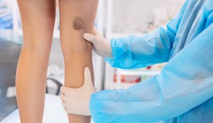 Modrice nisu uvek razlog za brigu ali na njih treba obratiti pažnju