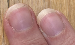 Objawy cukrzycy widać na paznokciach. Mały szczegół może być znaczący