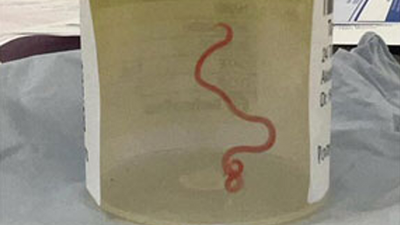 A live worm was found in a women's brain [skynews]