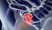 Osiem najczęstszych objawów raka jelita grubego