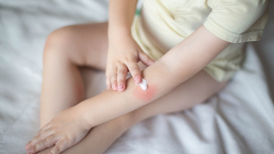 Oparzenia u dzieci - co na nie stosować i jak leczyć?