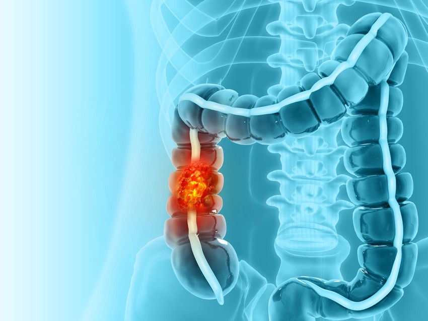Opstrukcija creva može da nastane zbog mase u debelom crevu, abnormalnog uvijanja creva ili adhezije