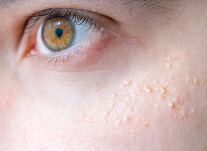 Mik azok a kis, fehér, kidudorodó pöttyök a bőrön? című cikk nyitóképe