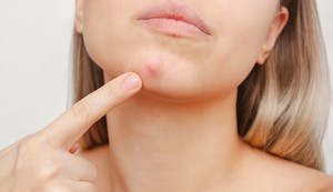 Mesto akni na licu pomaže u određivanju načina lečenja