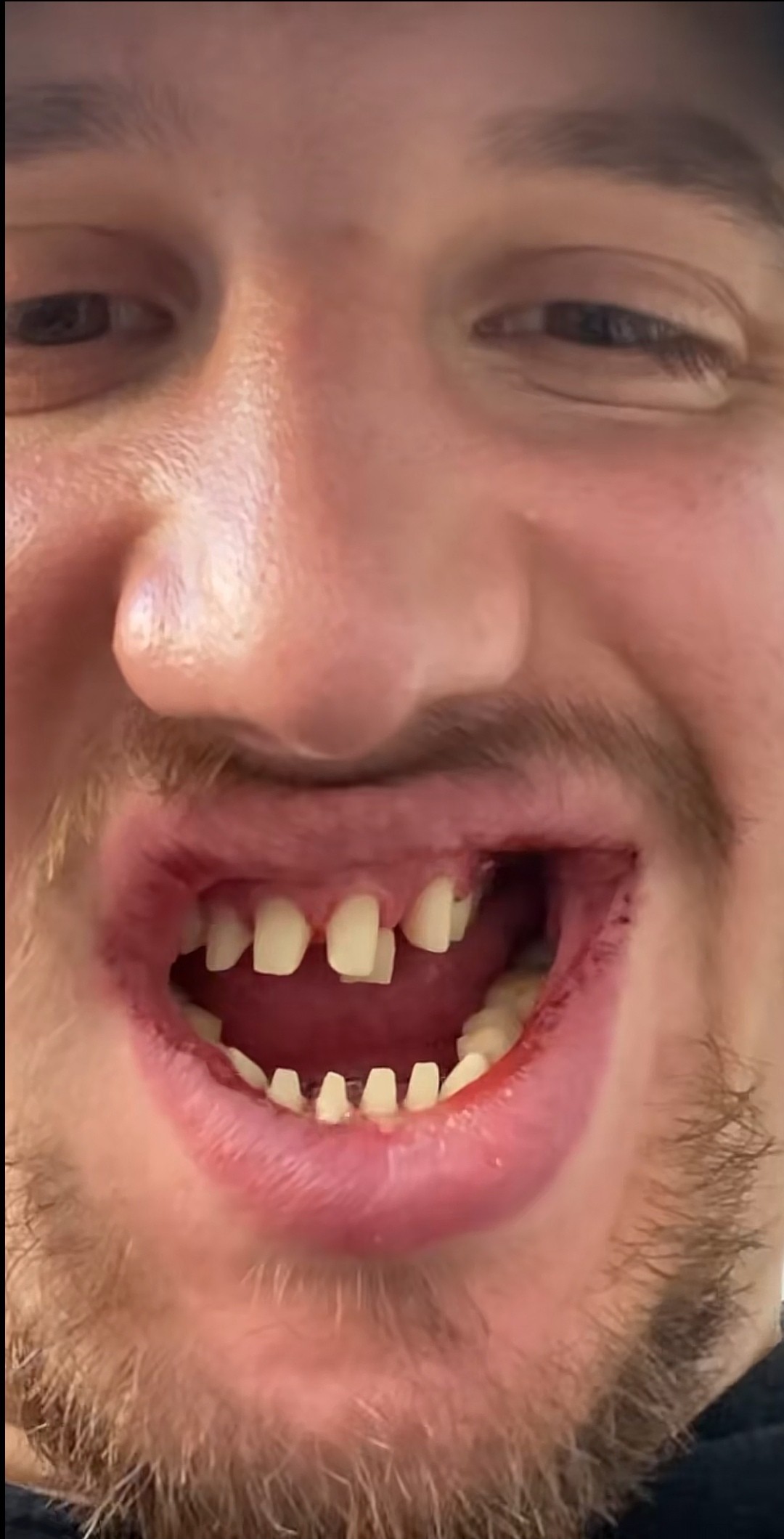 Dustin sa na TikToku pochválil svojím novým chrupom. 