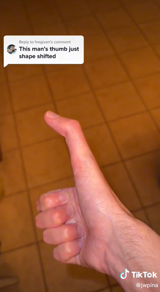 Jeho zvláštna anomália mu získala milióny zhliadnutí na sociálnej sieti TikTok. 