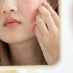 Kipirosodott az orra és az arca a tavaszi naptól? Rosacea is okozhatja