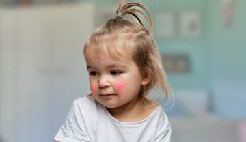 Alergia na białka mleka krowiego u dzieci – wszystko, co musisz wiedzieć