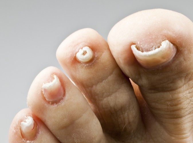 Grzybica zmienia płytkę paznokci