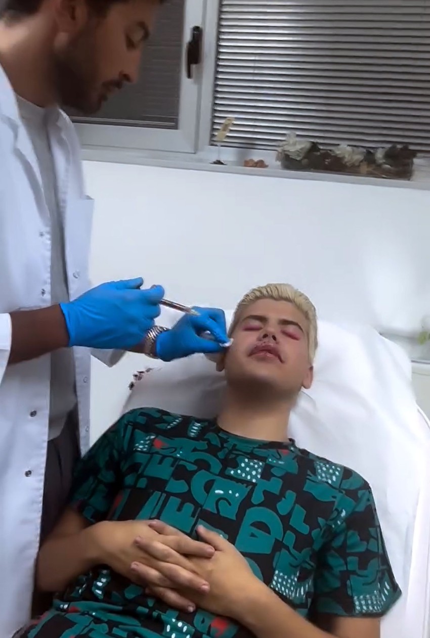 Uroš Stanić povećao usne i jagodice pred početak Elite 10