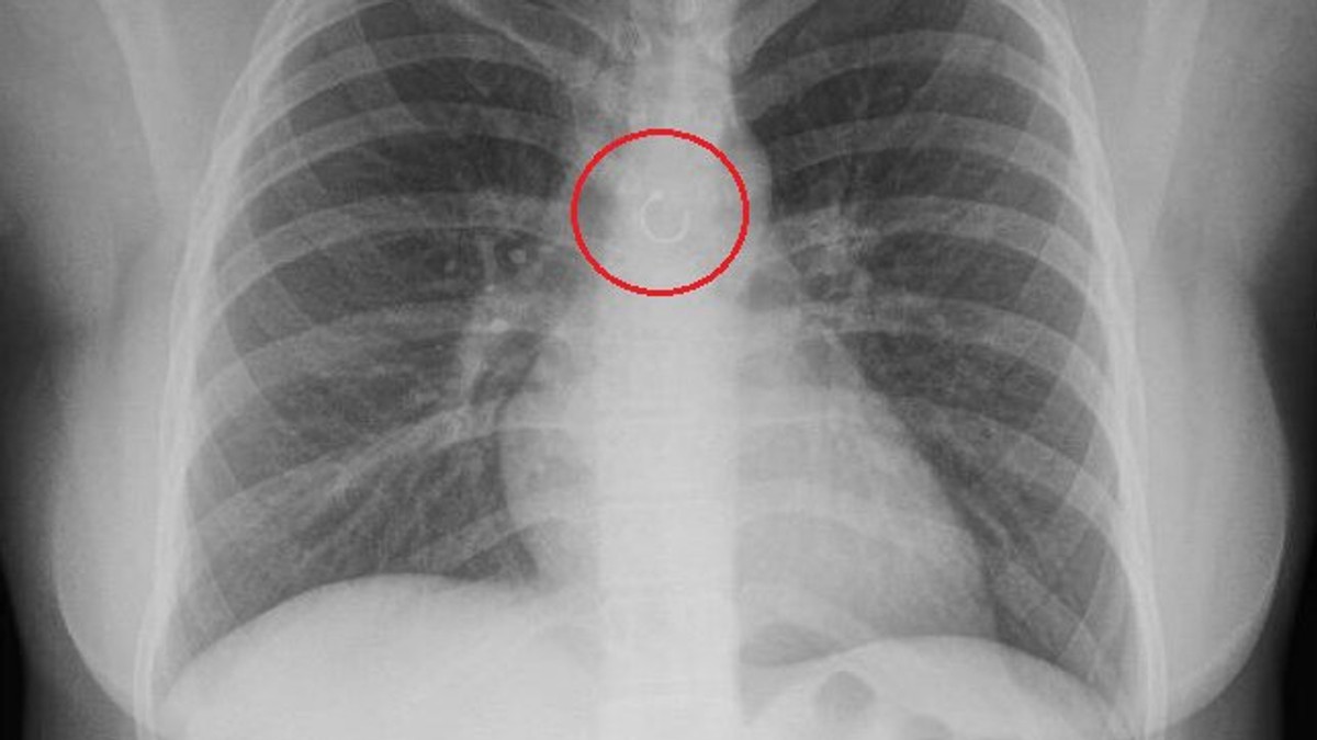 Imala je hroničan kašalj, a kad su lekari uradili snimak pluća zamalo nisu pali sa stolice