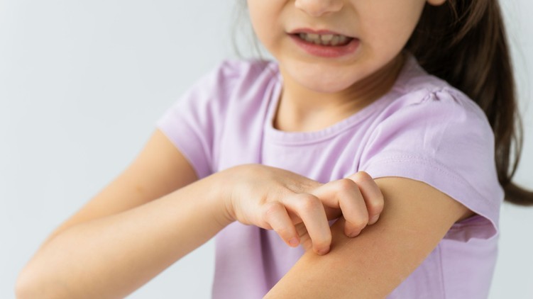 atópiás dermatitisz bőrgyulladás viszketés