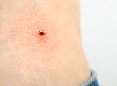Endometriózis és Lyme-kór: így függ össze a kettő betegség