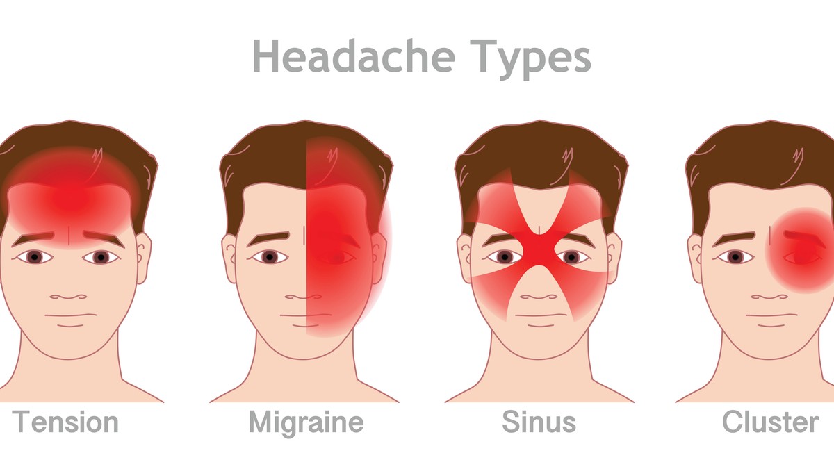 Vrste glavobolje u odnosu na mesto bola 