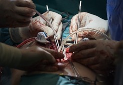 Tak się naprawia zastawkę w sercu i ratuje życie pacjenta [ZOBACZ ZDJĘCIA]