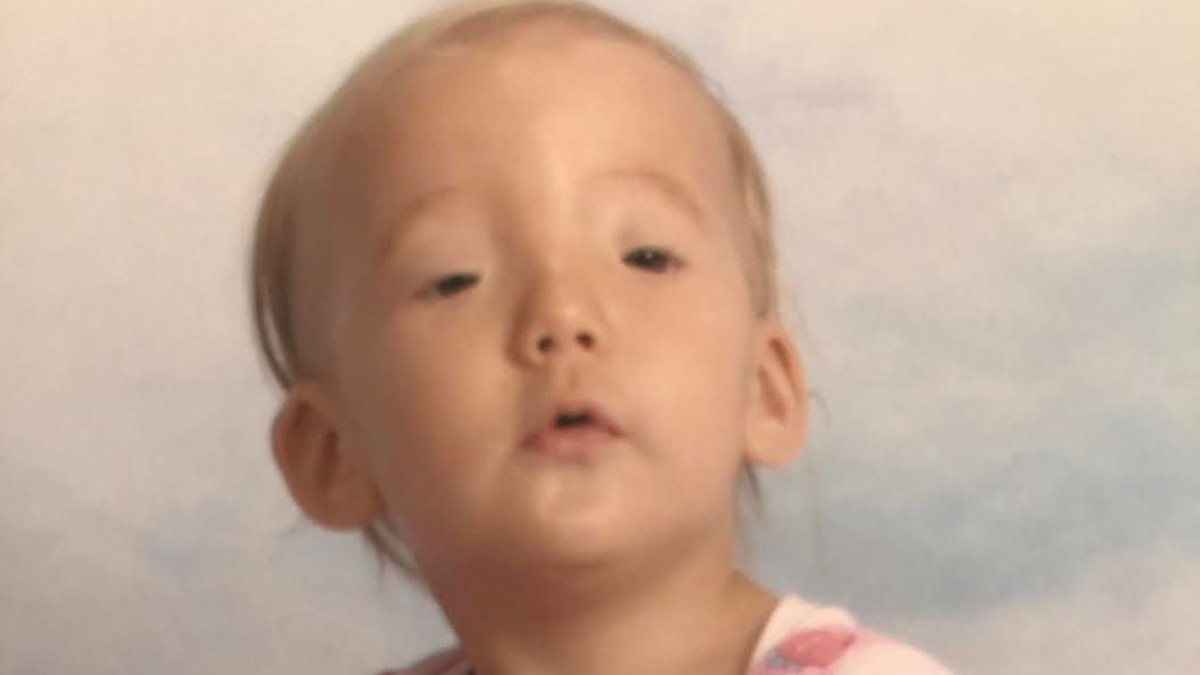 Ceo život su je vređali jer ne može da trepće: Operisana je sa 3 godine i evo kako izgleda