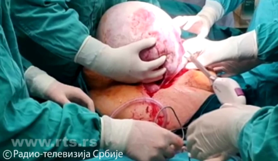 Odstranili joj tumor težak 50 kilograma!