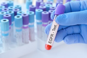 Mit jelent az eGFR érték a laborleleten?