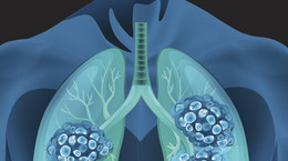 Rząd ignoruje chorych na raka płuca